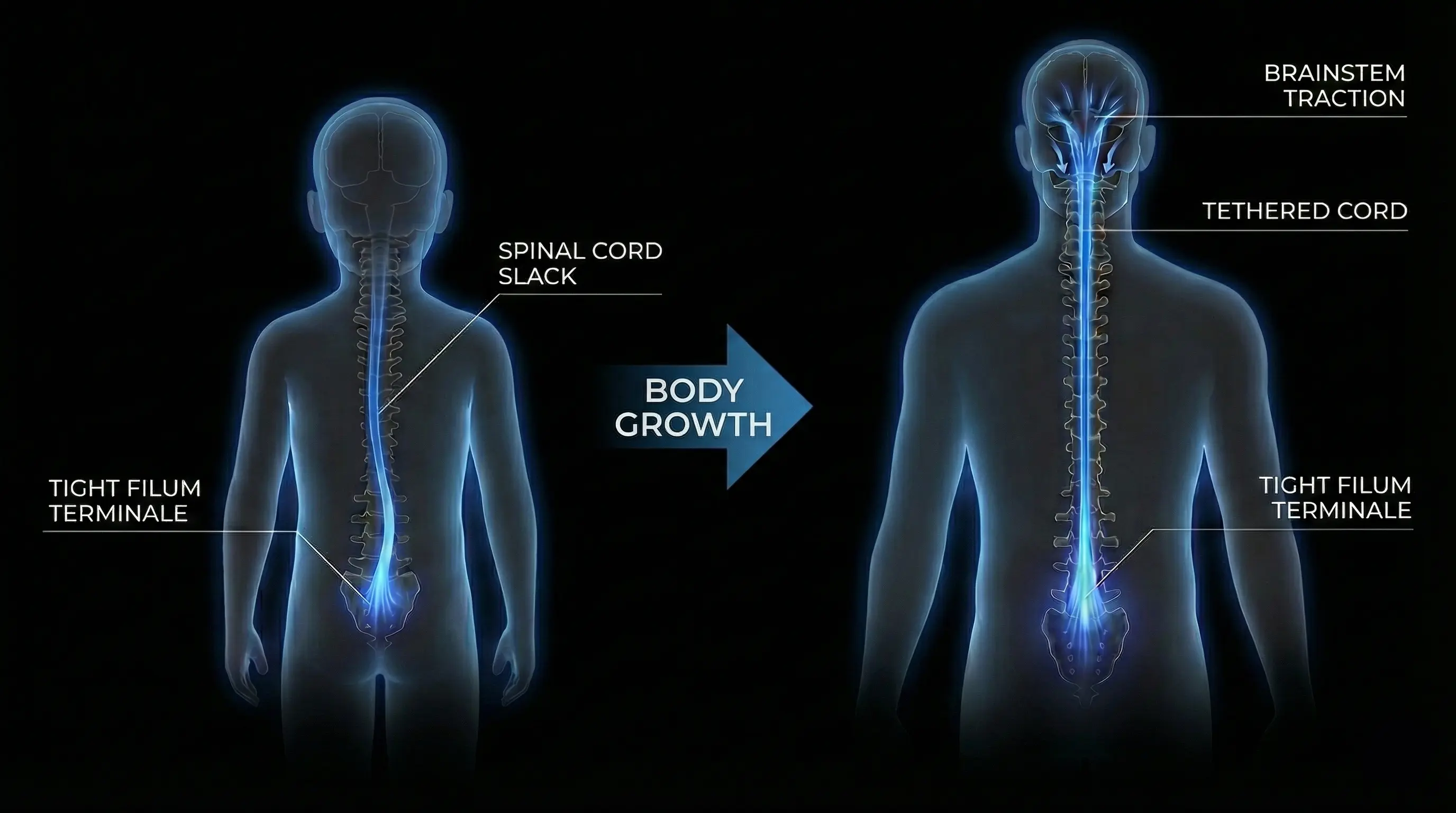 Diagram of spinal cord ascent (Ascensus Medullae) - dark mode