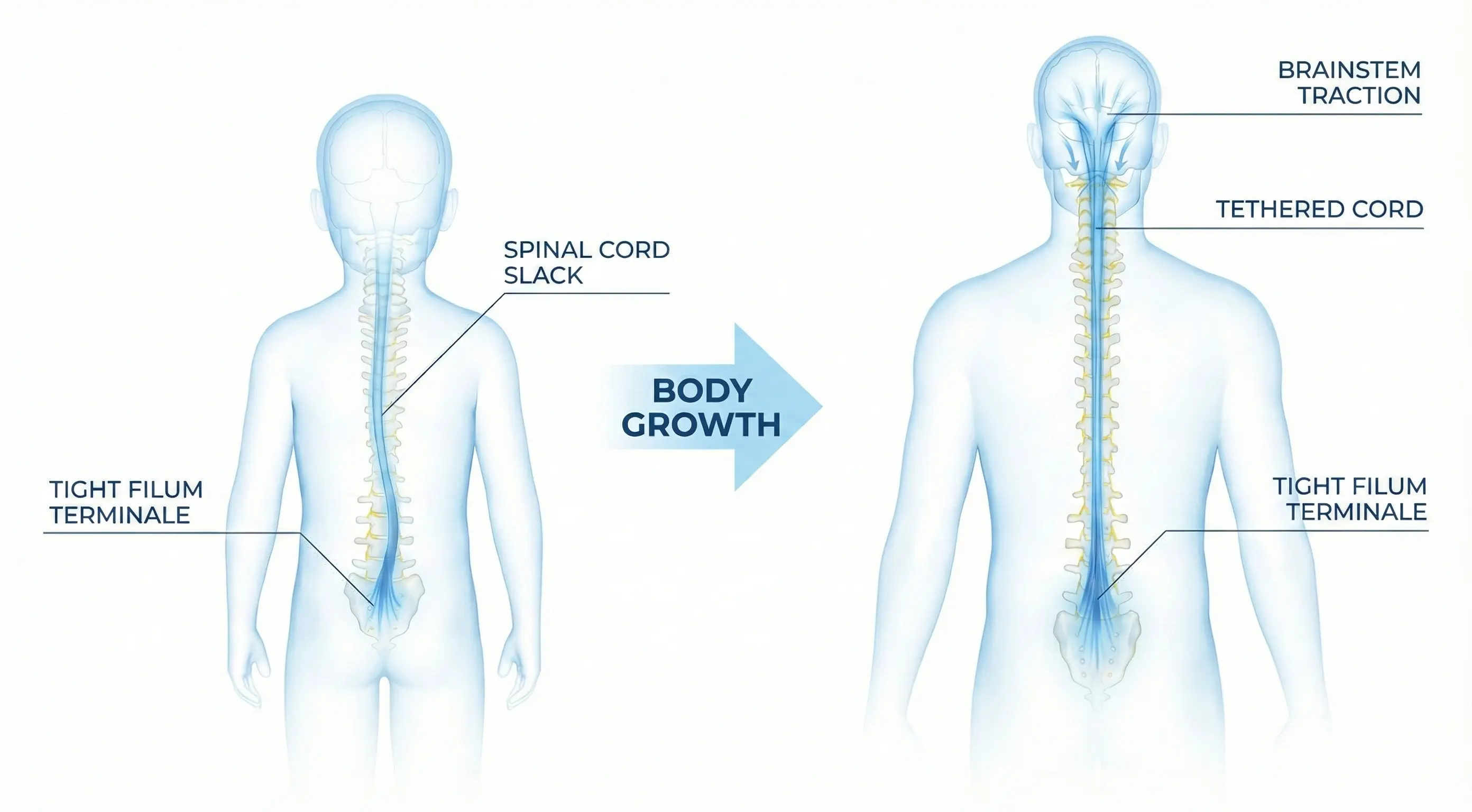 Diagram of spinal cord ascent (Ascensus Medullae)
