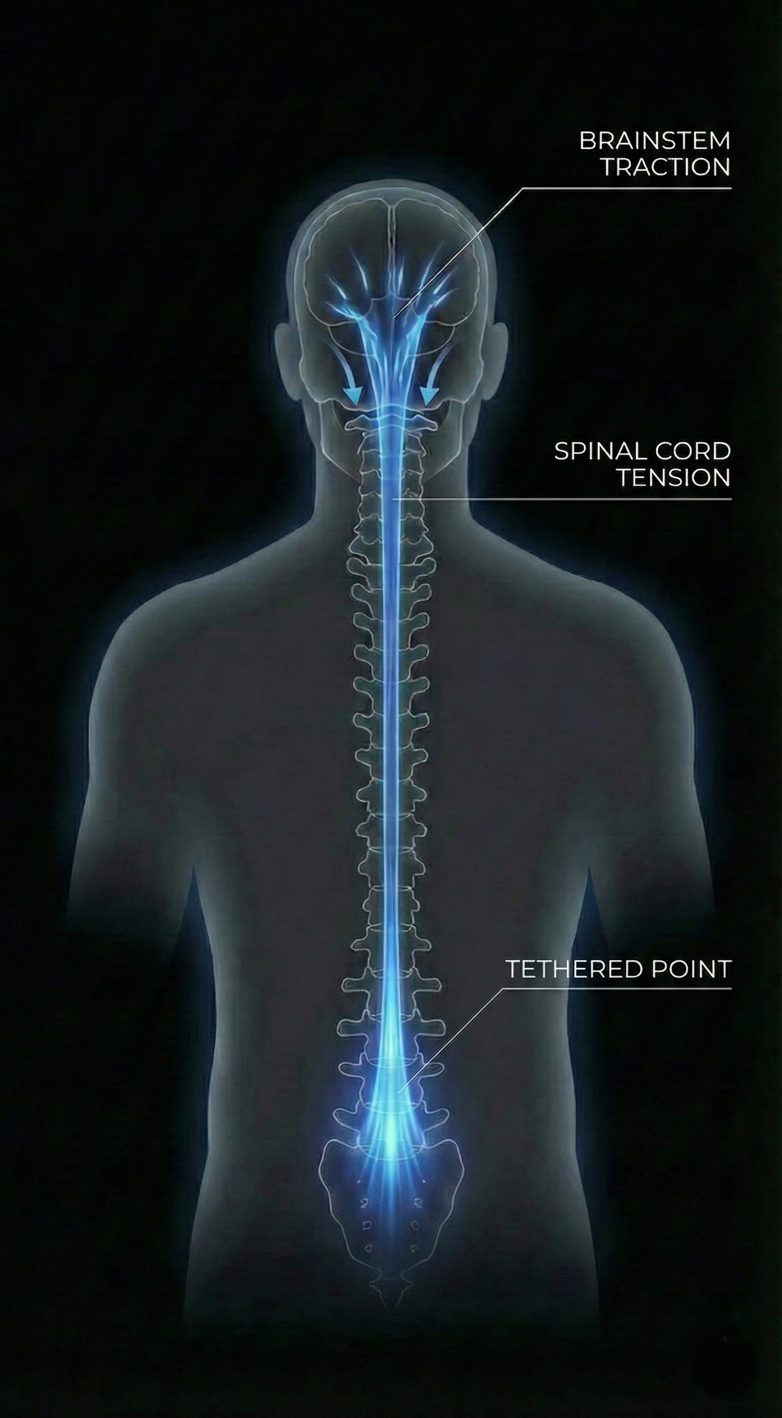 Diagram of Tethered Cord Syndrome (TCS) pathomechanism - dark mode