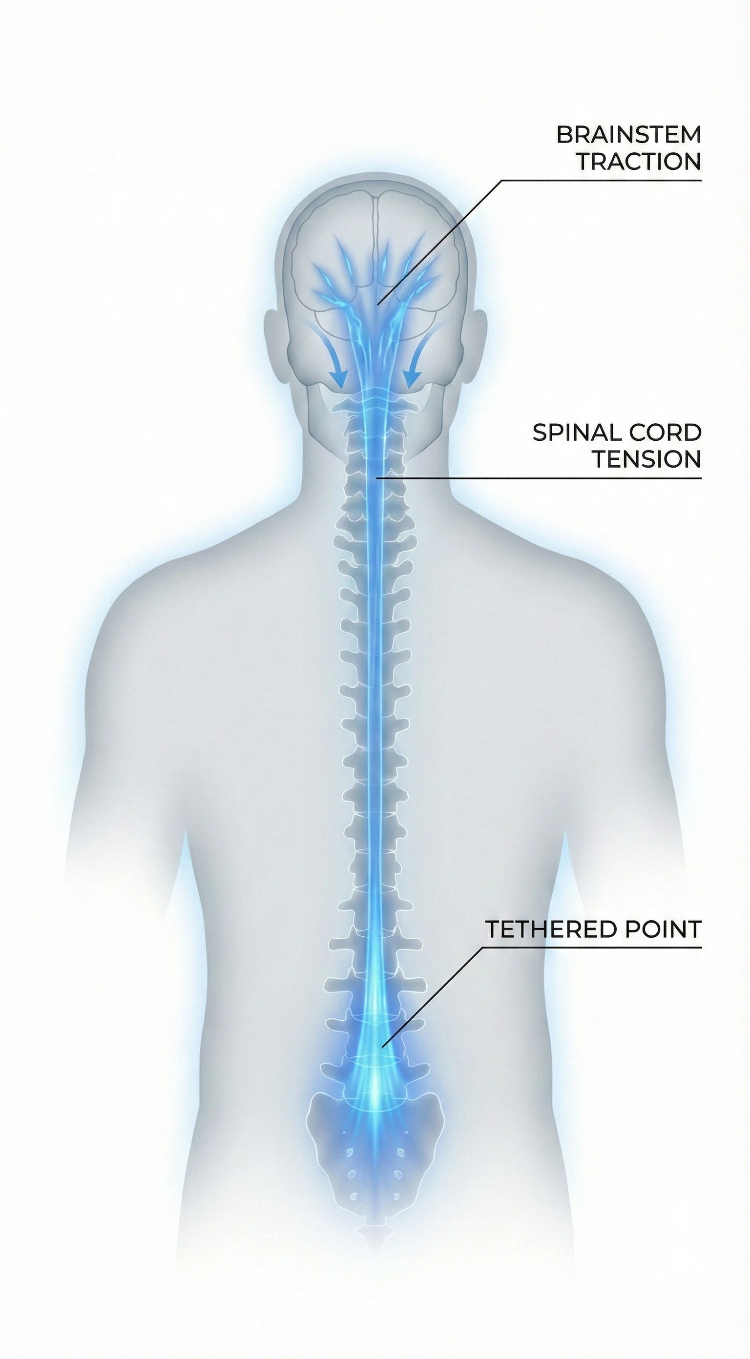Diagram of Tethered Cord Syndrome (TCS) pathomechanism